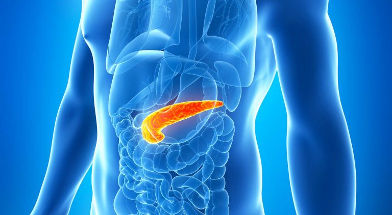 A new diagnostic to predict the patient response to FOLFIRINOX in pancreatic cancer